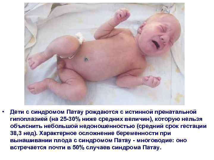  • Дети с синдромом Патау рождаются с истинной пренатальной  гипоплазией (на 25