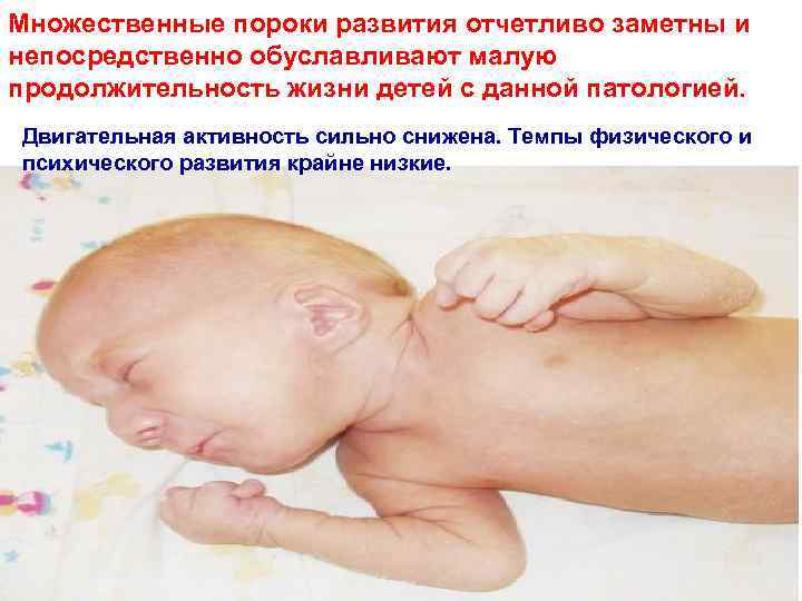Множественные пороки развития отчетливо заметны и непосредственно обуславливают малую продолжительность жизни детей с данной