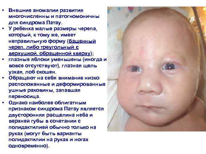  • Внешние аномалии развития  многочисленны и патогномоничны  для синдрома Патау. 