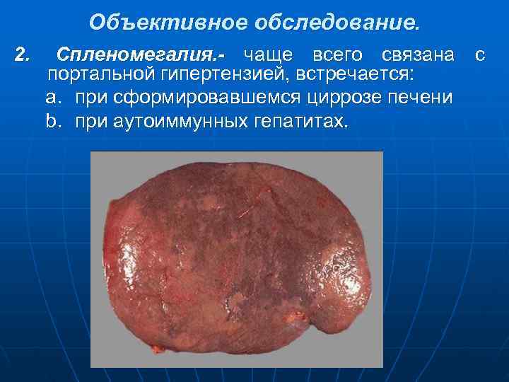   Объективное обследование. 2. Спленомегалия. - чаще всего связана с портальной гипертензией, встречается: