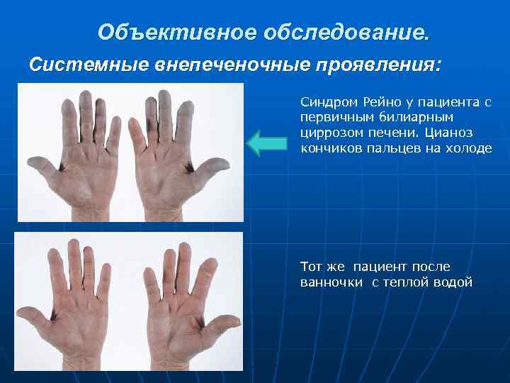  Объективное обследование. Системные внепеченочные проявления:     Синдром Рейно у пациента
