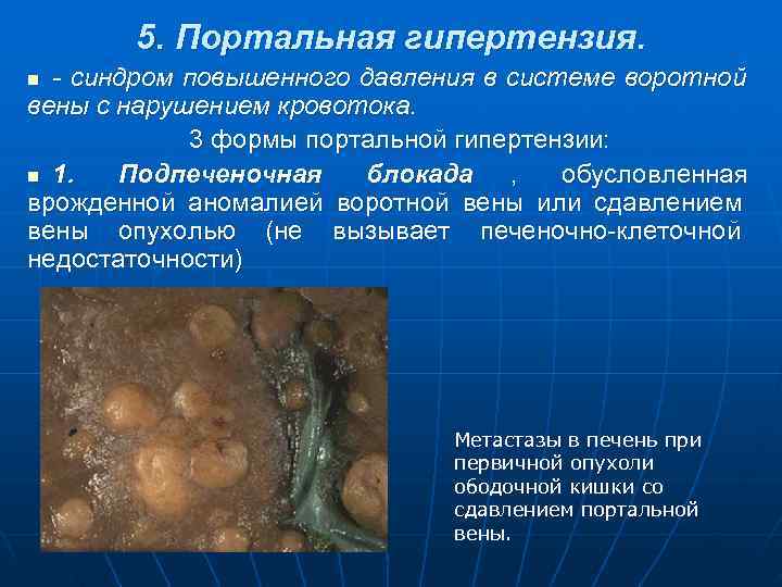   5. Портальная гипертензия. n - синдром повышенного давления в системе воротной вены