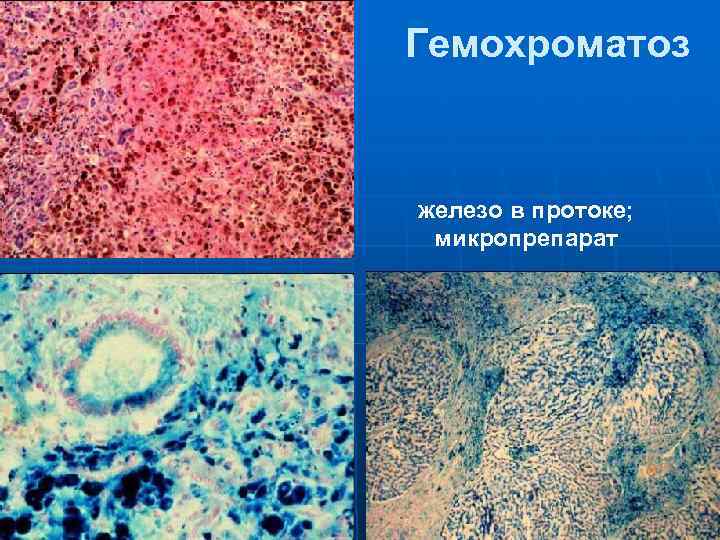 Гемохроматоз  железо в протоке;  микропрепарат 
