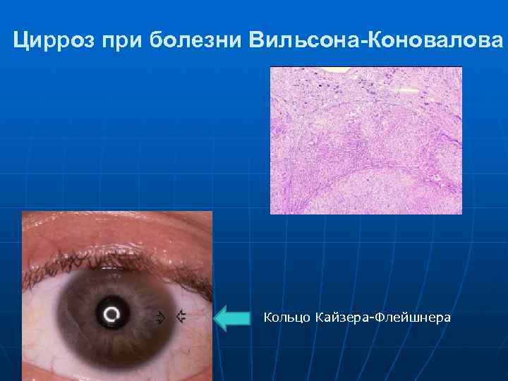 Цирроз при болезни Вильсона-Коновалова    Кольцо Кайзера-Флейшнера 