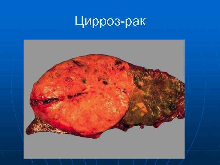 Цирроз-рак 