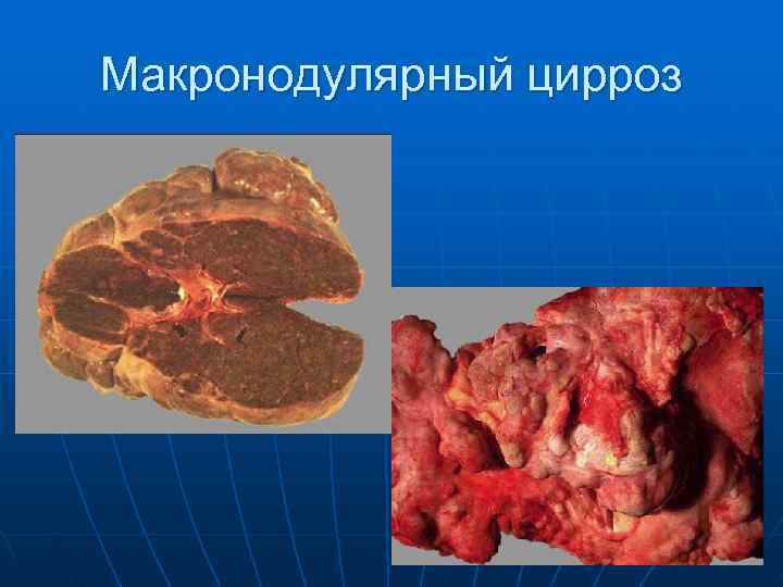 Макронодулярный цирроз 