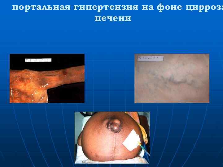 портальная гипертензия на фоне цирроза    печени 
