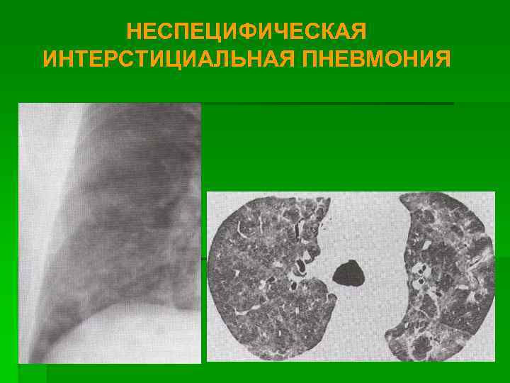 Интерстициальная пневмония. Неспецифический пневмонит кт. Острая интерстициальная пневмония кт. Неспецифическая интерстициальная пневмония кт. Интерстициальная пневмония кт.