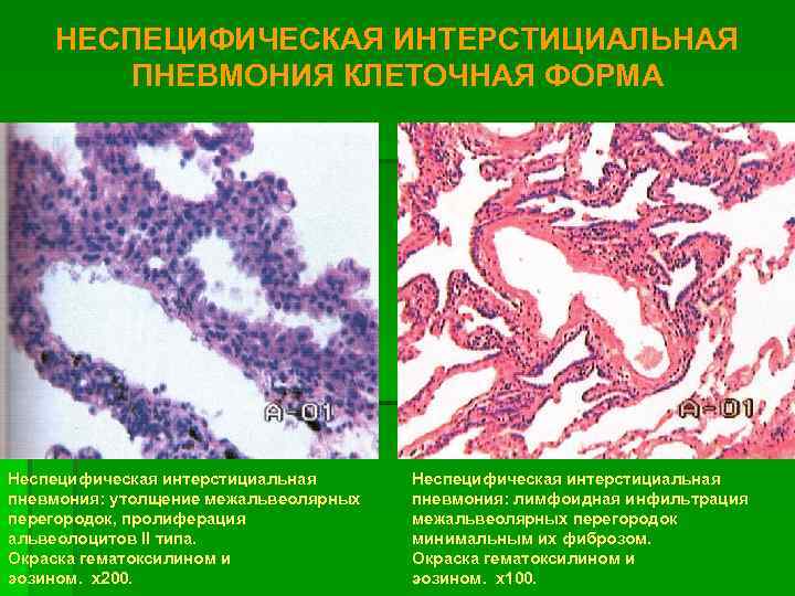 Неспецифические изменения. Неспецифическая интерстициальная пневмония гистология. Хроническая интерстициальная пневмония гистология. Интерстициальная пневмония гистология. Интерстициальная пневмония микропрепарат.