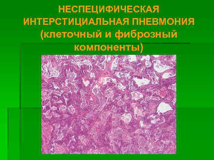 Интерстициальная пневмония. Интерстициальная пневмония гистология. Неспецифическая интерстициальная пневмония. Неспецифическая интерстициальная пневмония гистология. Хроническая интерстициальная пневмония гистология.