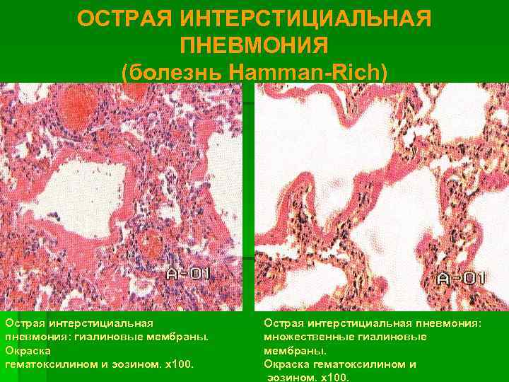 Интерстициальная пневмония