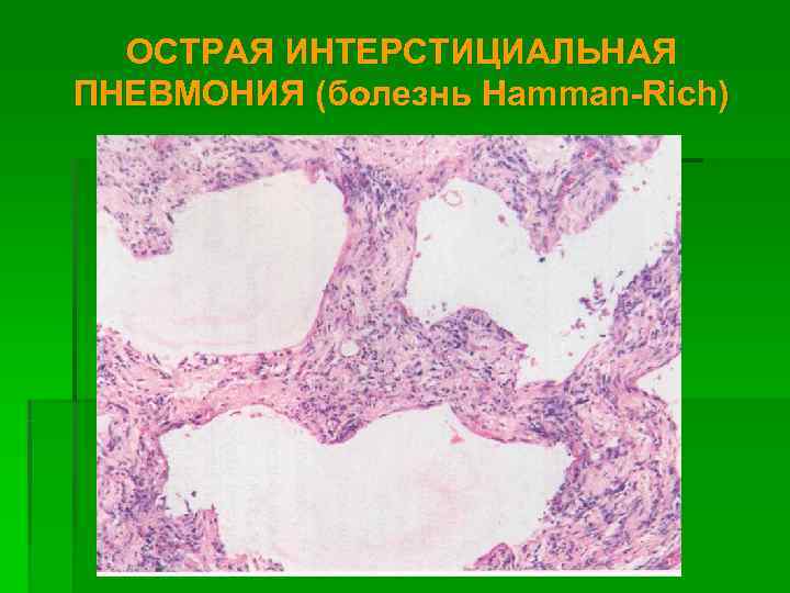 Патологическая анатомия презентации. Интерстициальная пневмония патологическая анатомия. Пневмония патологическая анатомия. Интерстициальная пневмония патанатомия. Пневмококковая пневмония патологическая анатомия.