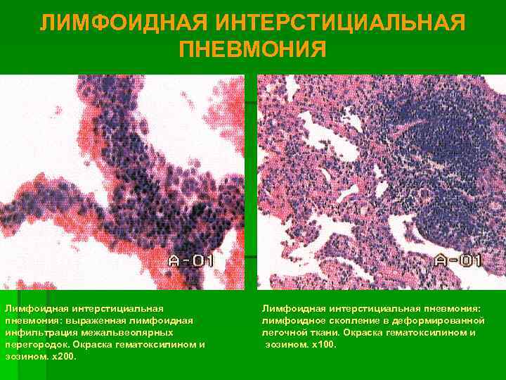 Лимфоцитарная интерстициальная пневмония. Лимфоидная интерстициальная пневмония. Неспецифическая интерстициальная пневмония. Лимфоидноклеточная инфильтрация.