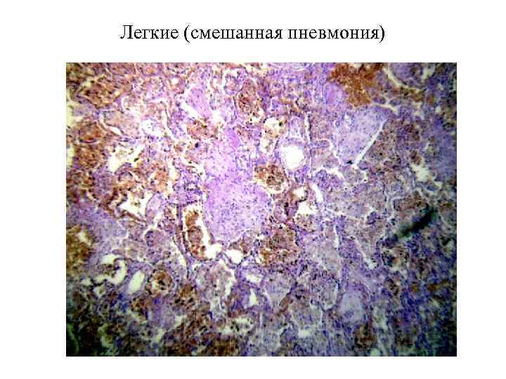Легкие (смешанная пневмония) 