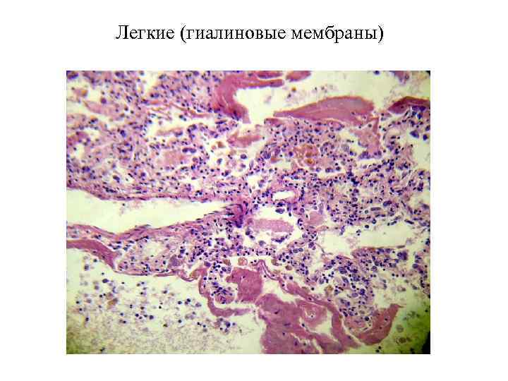 Легкие (гиалиновые мембраны) 