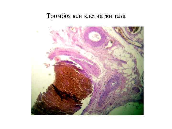 Тромбоз вен клетчатки таза 