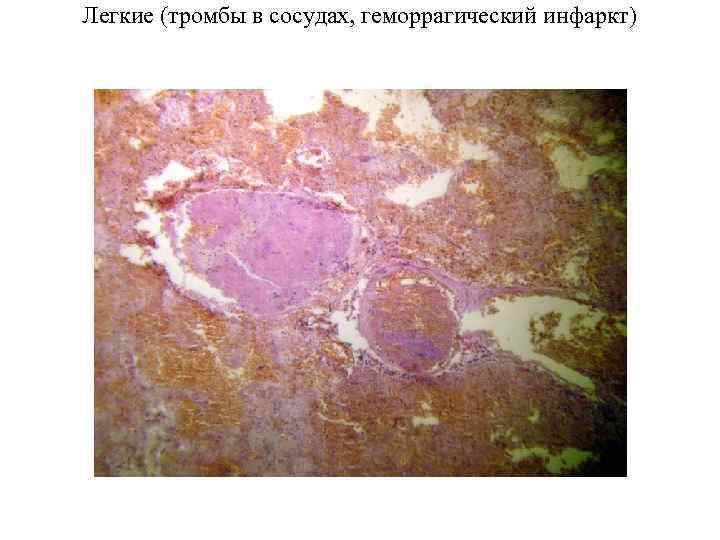 Легкие (тромбы в сосудах, геморрагический инфаркт) 