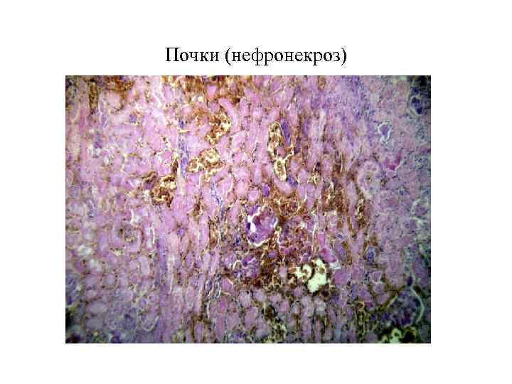 Почки (нефронекроз) 