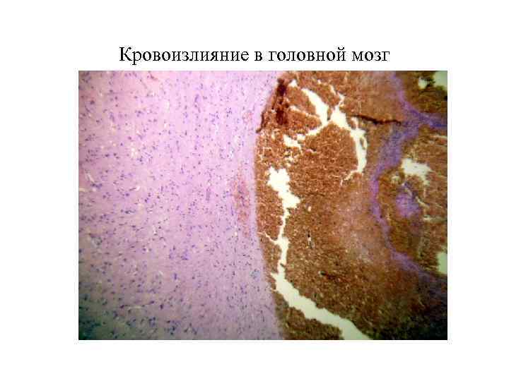 Кровоизлияние в головной мозг 
