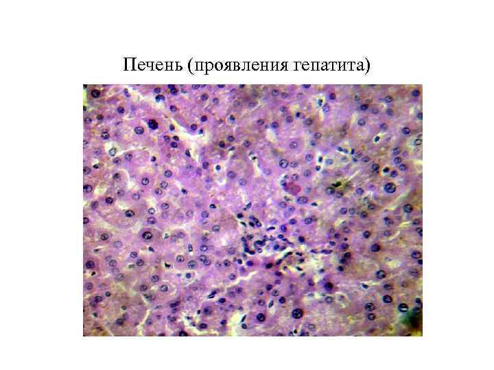 Печень (проявления гепатита) 