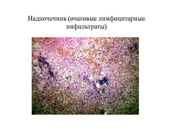 Надпочечник (очаговые лимфоцитарные  инфильтраты) 