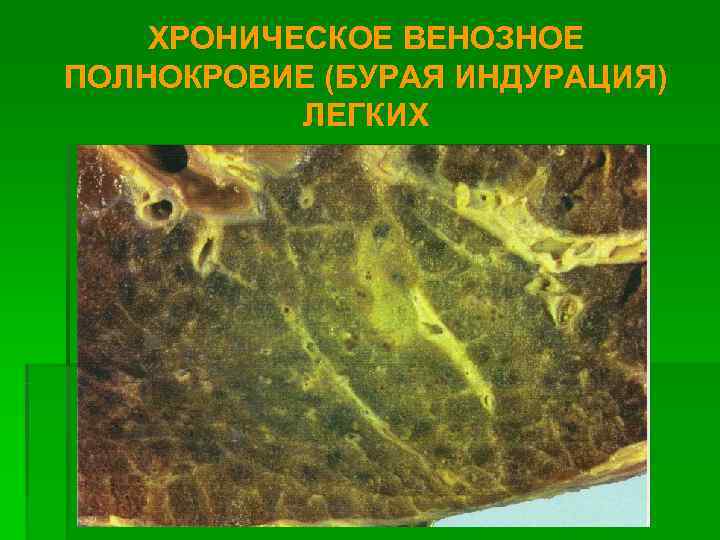   ХРОНИЧЕСКОЕ ВЕНОЗНОЕ ПОЛНОКРОВИЕ (БУРАЯ ИНДУРАЦИЯ)  ЛЕГКИХ 