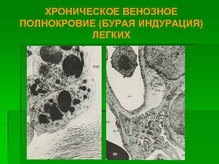   ХРОНИЧЕСКОЕ ВЕНОЗНОЕ ПОЛНОКРОВИЕ (БУРАЯ ИНДУРАЦИЯ)  ЛЕГКИХ 