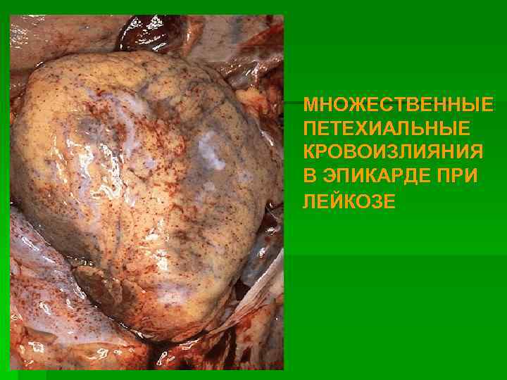 МНОЖЕСТВЕННЫЕ ПЕТЕХИАЛЬНЫЕ КРОВОИЗЛИЯНИЯ В ЭПИКАРДЕ ПРИ ЛЕЙКОЗЕ 