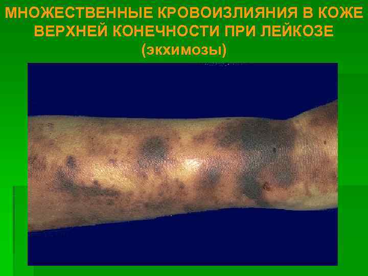 МНОЖЕСТВЕННЫЕ КРОВОИЗЛИЯНИЯ В КОЖЕ  ВЕРХНЕЙ КОНЕЧНОСТИ ПРИ ЛЕЙКОЗЕ   (экхимозы) 
