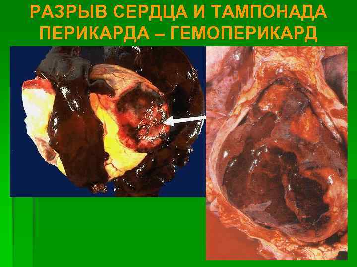 РАЗРЫВ СЕРДЦА И ТАМПОНАДА ПЕРИКАРДА – ГЕМОПЕРИКАРД 
