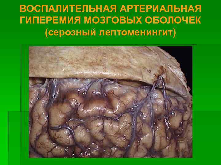 ВОСПАЛИТЕЛЬНАЯ АРТЕРИАЛЬНАЯ ГИПЕРЕМИЯ МОЗГОВЫХ ОБОЛОЧЕК (серозный лептоменингит) 