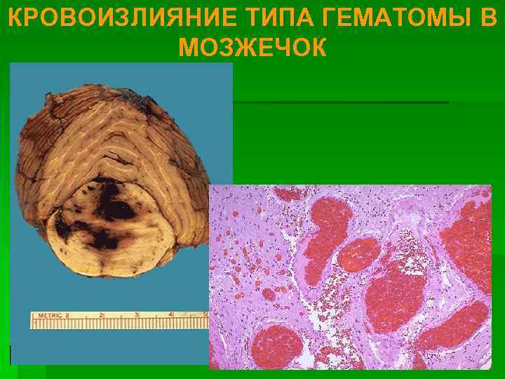 КРОВОИЗЛИЯНИЕ ТИПА ГЕМАТОМЫ В  МОЗЖЕЧОК 