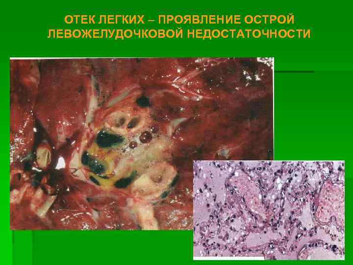  ОТЕК ЛЕГКИХ – ПРОЯВЛЕНИЕ ОСТРОЙ ЛЕВОЖЕЛУДОЧКОВОЙ НЕДОСТАТОЧНОСТИ 