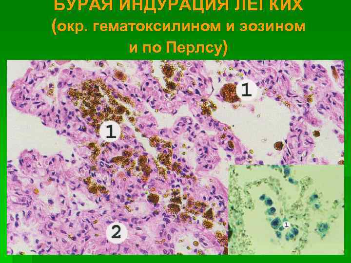 Бурая индурация легких это. Бурая индурация легких микропрепарат реакция Перлса. Бурая индурация легких реакция Перлса. Бурая индурация легкого микропрепарат реакция Перлса. Бурая индурация легких микропрепарат по Перлсу.