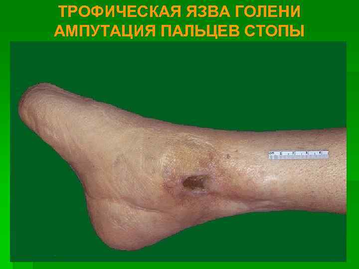 ТРОФИЧЕСКАЯ ЯЗВА ГОЛЕНИ АМПУТАЦИЯ ПАЛЬЦЕВ СТОПЫ 