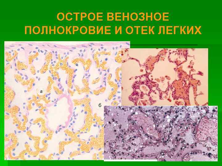   ОСТРОЕ ВЕНОЗНОЕ ПОЛНОКРОВИЕ И ОТЕК ЛЕГКИХ 