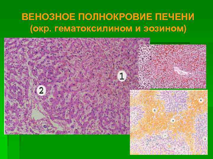 ВЕНОЗНОЕ ПОЛНОКРОВИЕ ПЕЧЕНИ (окр. гематоксилином и эозином) 