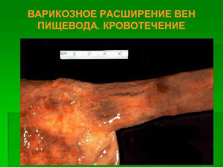 ВАРИКОЗНОЕ РАСШИРЕНИЕ ВЕН ПИЩЕВОДА. КРОВОТЕЧЕНИЕ 