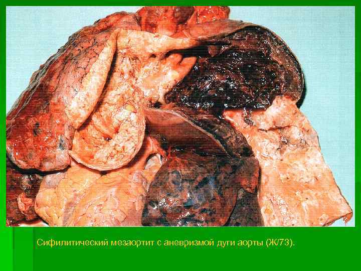 Сифилитический мезаортит с аневризмой дуги аорты (Ж/73). 