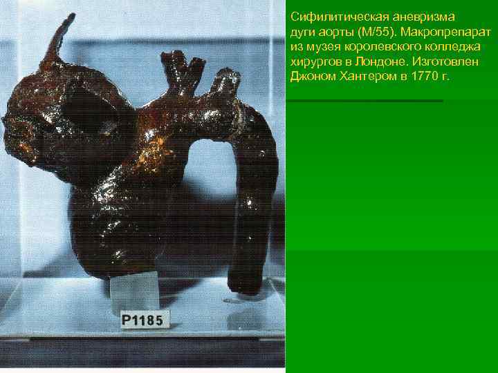 Сифилитическая аневризма дуги аорты (М/55). Макропрепарат из музея королевского колледжа хирургов в Лондоне. Изготовлен
