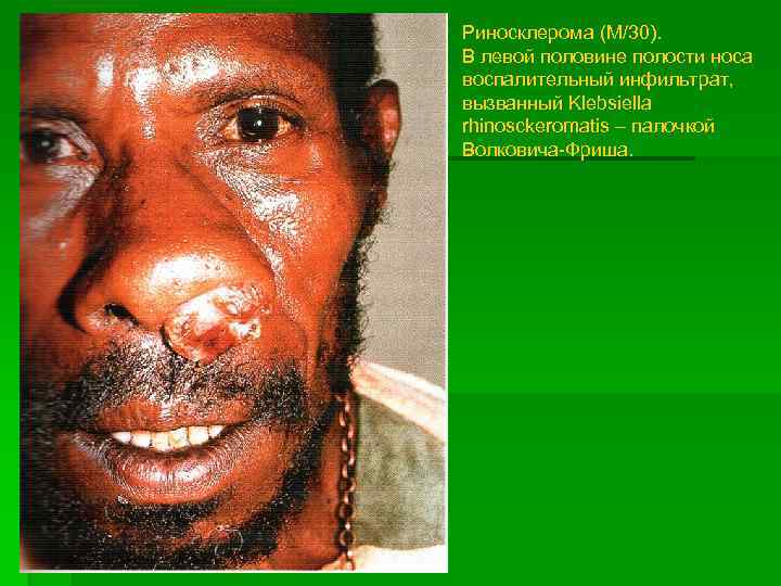 Риносклерома (М/30). В левой половине полости носа воспалительный инфильтрат, вызванный Klebsiella rhinosckeromatis – палочкой