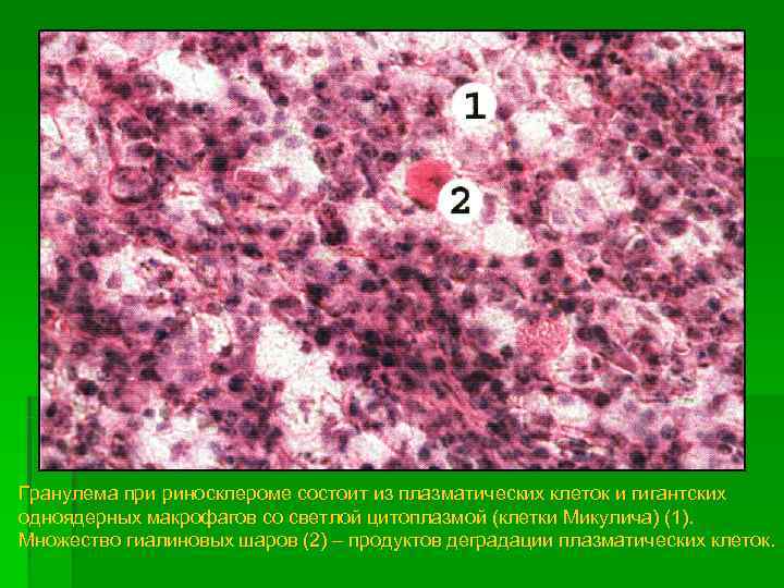 Туберкулезный латынь. Риносклерома гистология. Клетки Микулича это патанатомия. Склеромная гранулема патанатомия.