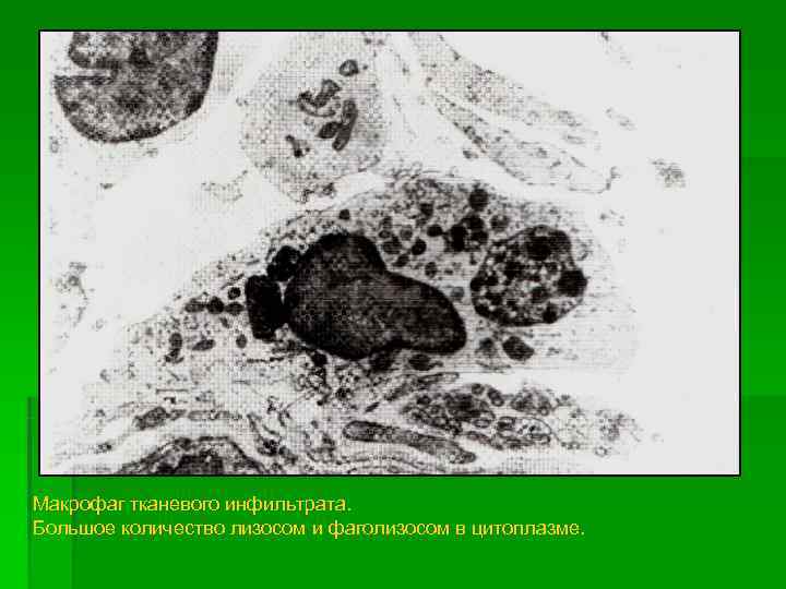 Макрофаг тканевого инфильтрата. Большое количество лизосом и фаголизосом в цитоплазме. 
