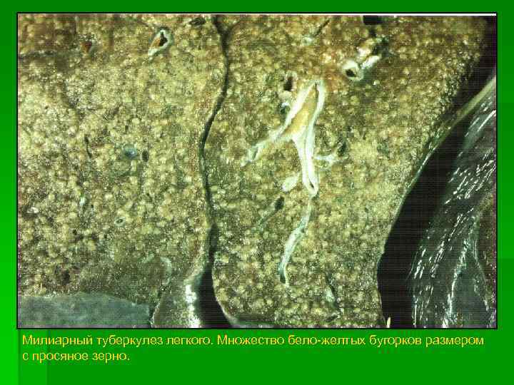 Милиарный туберкулез легкого. Множество бело-желтых бугорков размером с просяное зерно. 