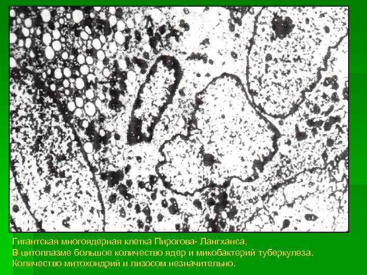 Гигантская многоядерная клетка Пирогова- Лангханса. В цитоплазме большое количество ядер и микобактерий туберкулеза. Количество