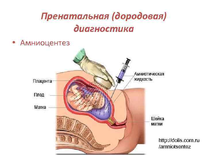  Пренатальная (дородовая)   диагностика • Амниоцентез      