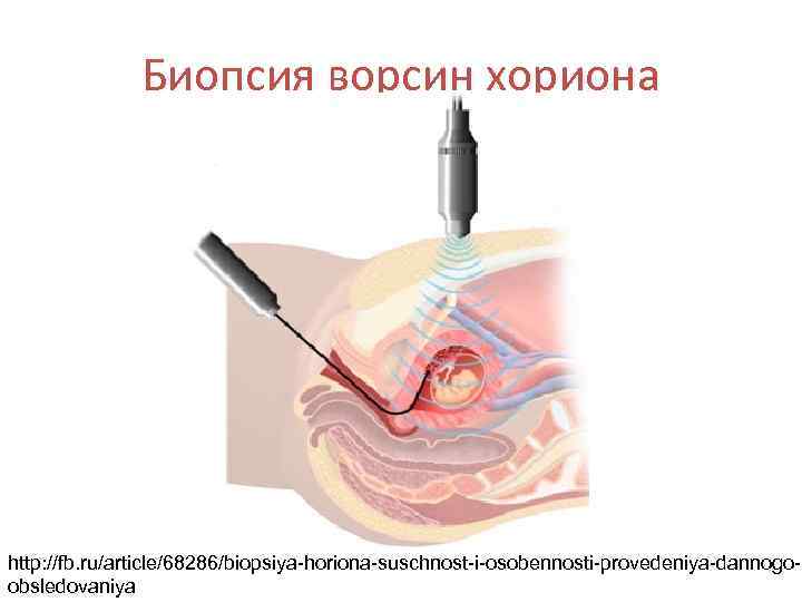    Биопсия ворсин хориона http: //fb. ru/article/68286/biopsiya-horiona-suschnost-i-osobennosti-provedeniya-dannogo- obsledovaniya 