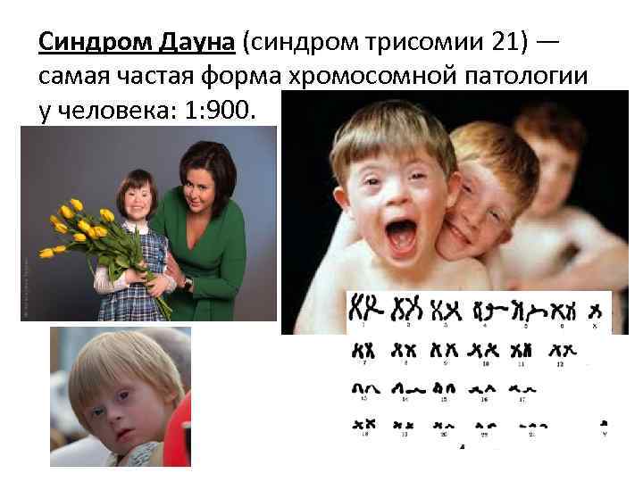 Синдром Дауна (синдром трисомии 21) — самая частая форма хромосомной патологии у человека: 1: