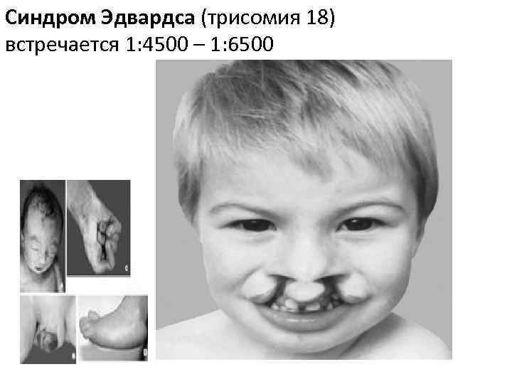 Синдром Эдвардса (трисомия 18) встречается 1: 4500 – 1: 6500 