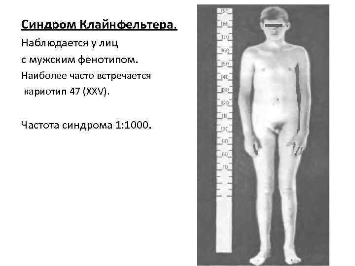 Синдром Клайнфельтера. Наблюдается у лиц с мужским фенотипом. Наиболее часто встречается кариотип 47 (XXV).